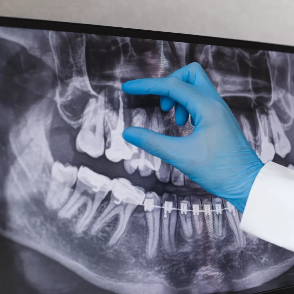 OPG-XRAY-Graphy-2048x1365